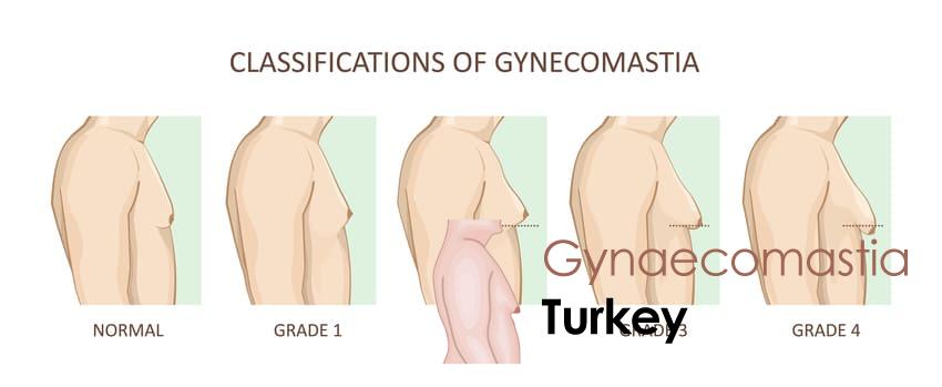 gynaecomastia turkey antalya